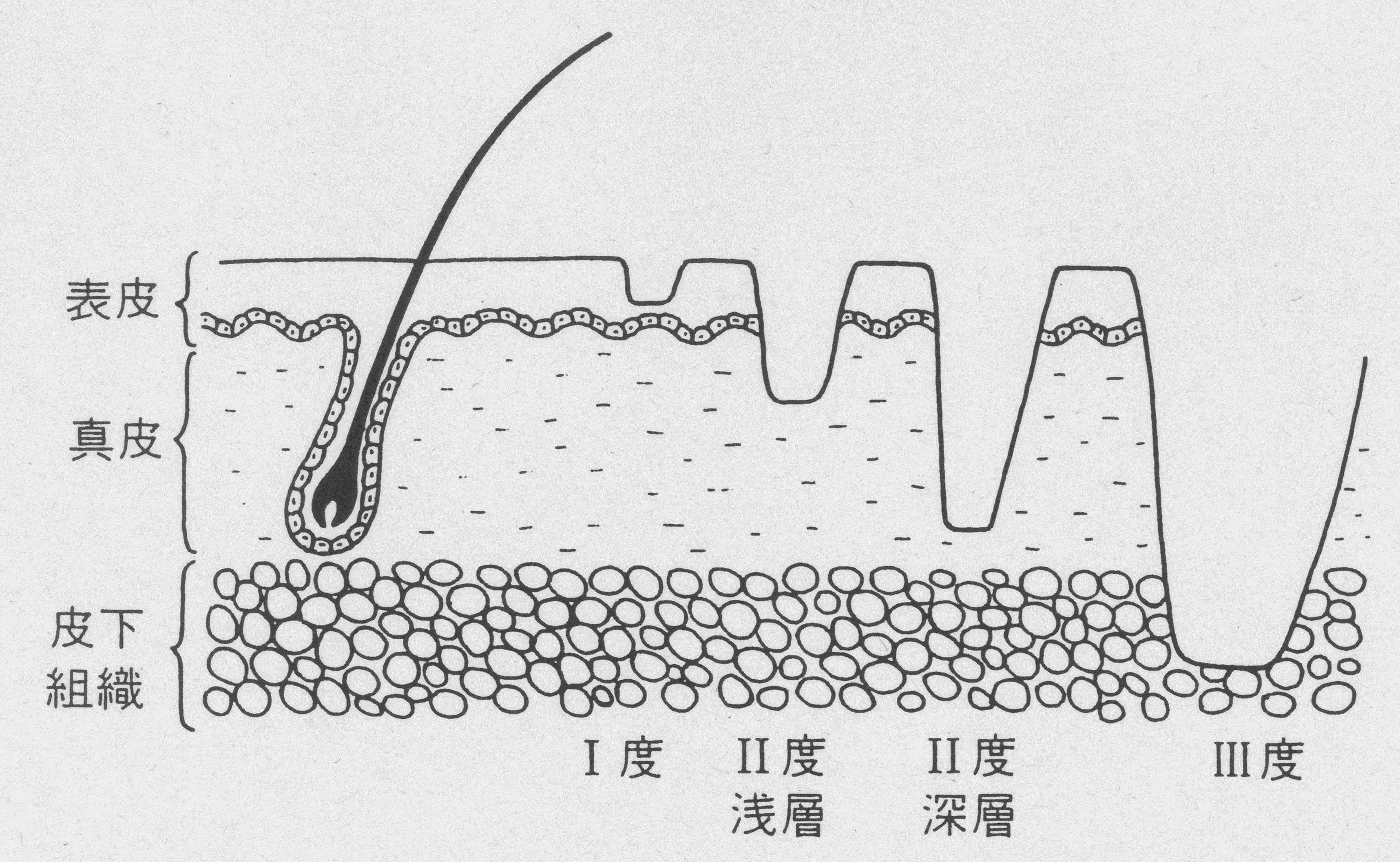 の 水ぶくれ どうする やけど は やけどでできた水ぶくれを放置するとどうなる？／勝手に治るもの？