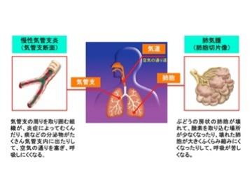 COPDの発症原因の図