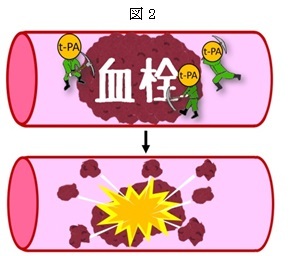 血栓を溶かすお薬の点滴