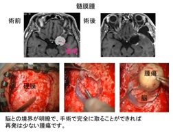 髄膜腫の画像
