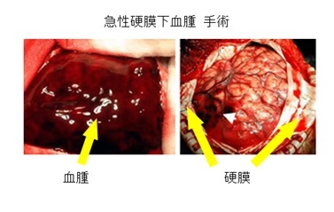 急性硬膜下血腫の手術の画像