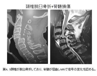 頸椎脱臼骨折＋脊髄損傷の画像
