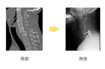 脊椎脊髄外傷の手術の術前、術後