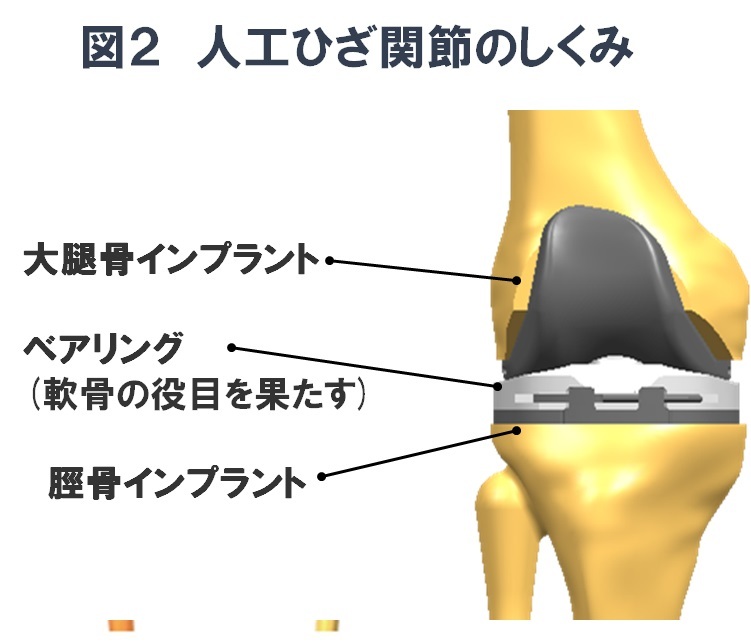 人口膝関節の仕組みの図