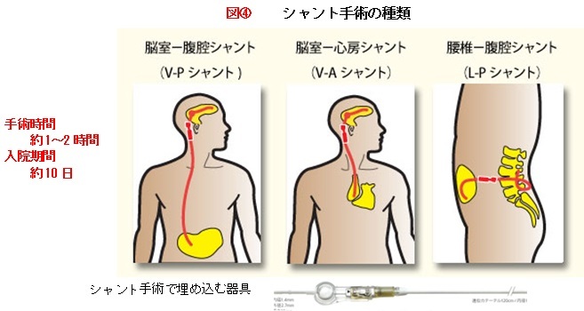 シャント手術の種類