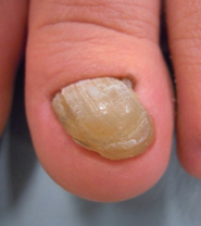 知って得する病気の話 爪の病気について 皮膚科 彦根市立病院