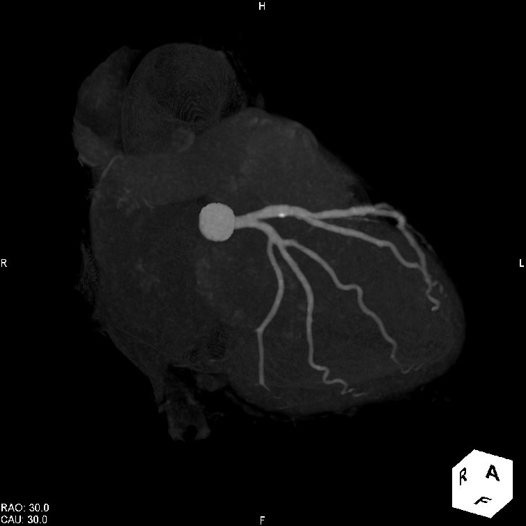 左冠動脈MIP画像