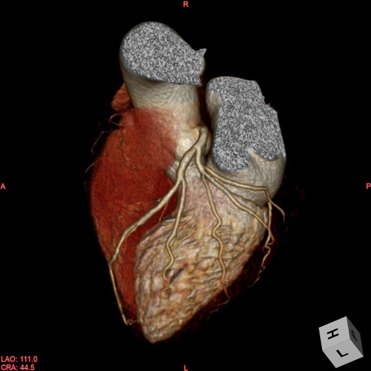 心臓3D画像