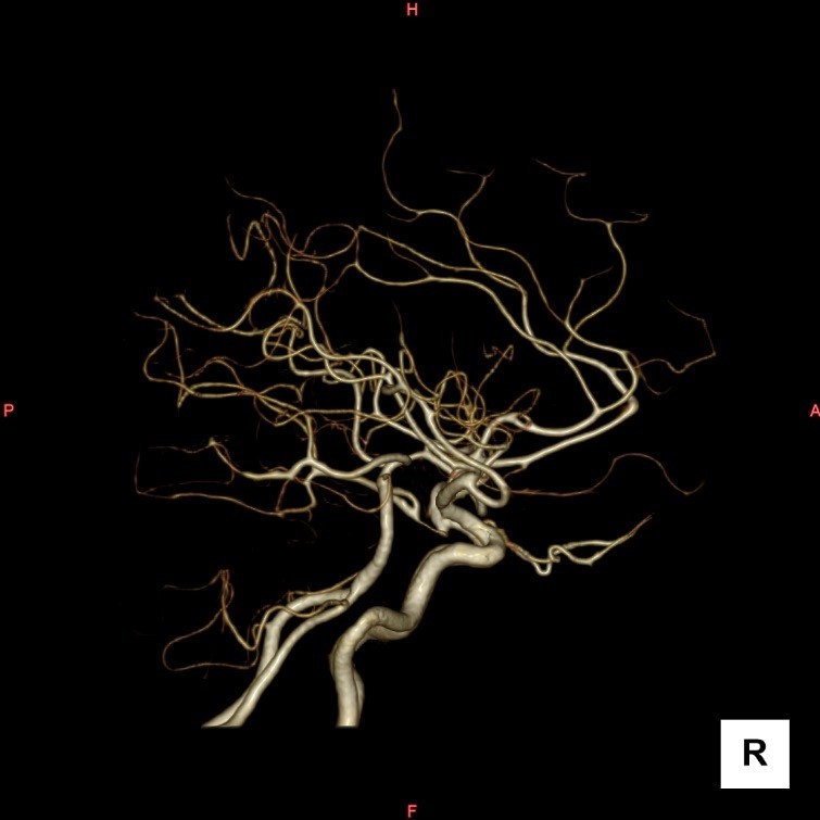 頭部血管3D画像(側面)