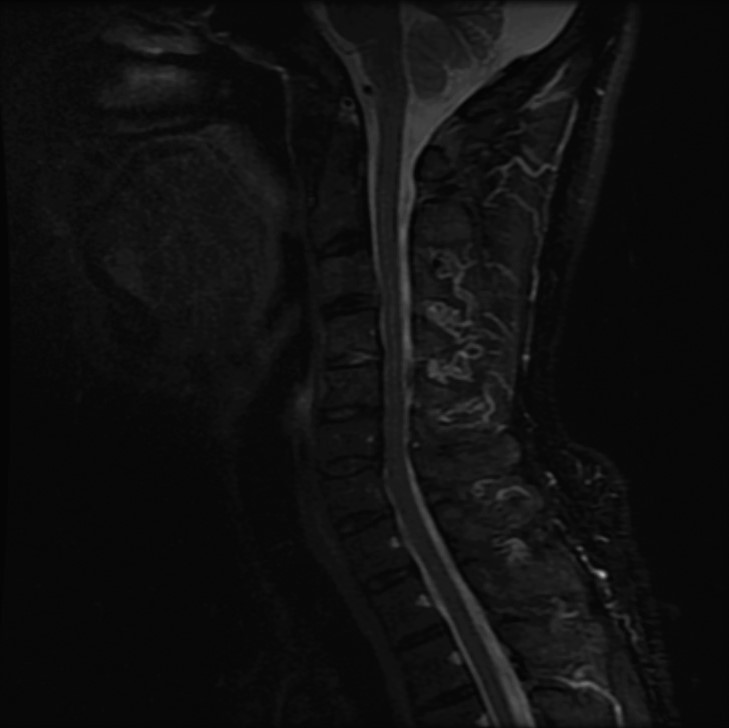 頚部STIR画像(Sag)