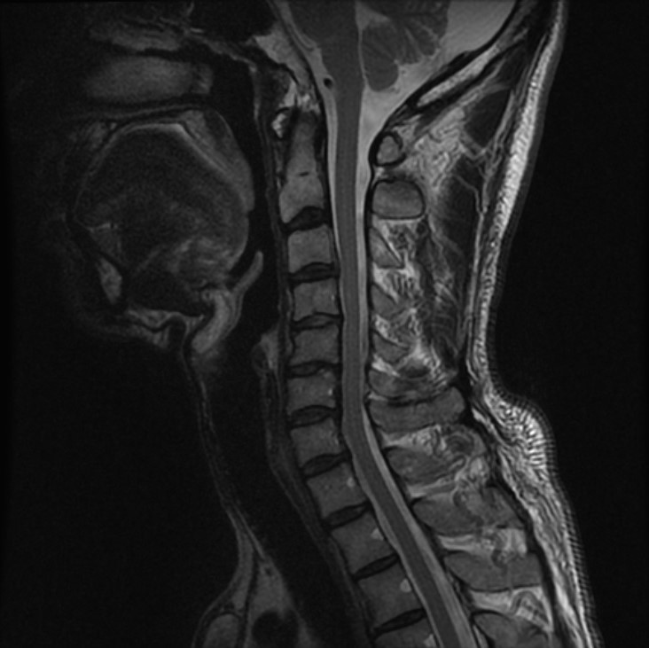 頚部T2画像(Sag)